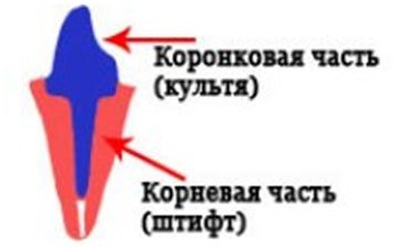 vnutrikornevaya kultevaya vkladka 1