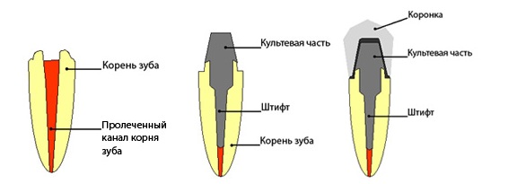 vnutrikornevaya kultevaya vkladka 4