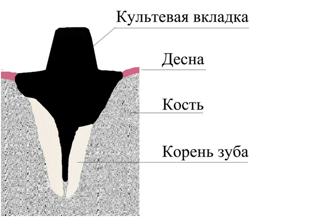 vnutrikornevaya kultevaya vkladka 7