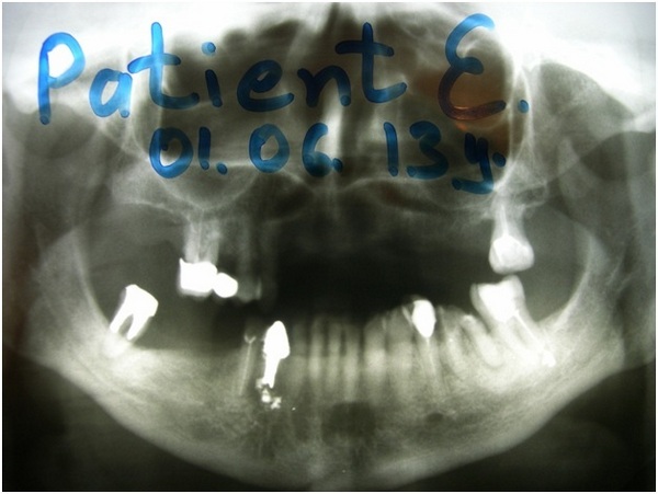 pacient 1 5