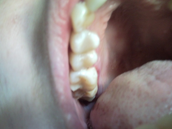pacient 11 2